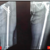 Fracture Occurrence following Prophylactic Nailing in a Case of Bisphosphonate-induced Atypical Femoral Fracture – A Rare Case Report