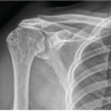 A Silent Shoulder of Plentiful Pathology: An Uncommon Presentation of Acromioclavicular Ganglion Cyst