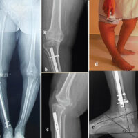 Figure 1: Pre-operative (Case 1) (a) Long-leg composite radiograph, (b) Anteroposterior view (c) Lateral views, (d) Standing photograph showing recurvatum deformity (e) Radiograph of the ankle showing calcaneus deformity (A-Tibiocalcaneal angle - 36°, B -Calcaneal pitch - 44°, C-Talocalcaneal angle - 61°).