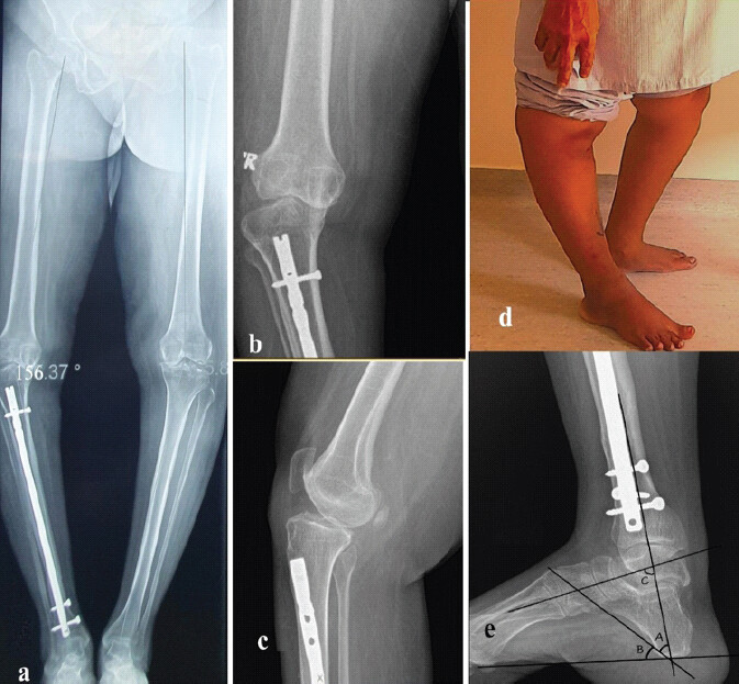 Figure 1: Pre-operative (Case 1) (a) Long-leg composite radiograph, (b) Anteroposterior view (c) Lateral views, (d) Standing photograph showing recurvatum deformity (e) Radiograph of the ankle showing calcaneus deformity (A-Tibiocalcaneal angle - 36°, B -Calcaneal pitch - 44°, C-Talocalcaneal angle - 61°).