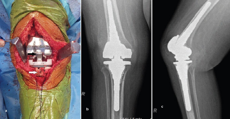 Figure 2: (a) Intraoperative photograph showing cortical window for nail removal (white arrow) and extension-stop mechanism of rotating hinge knee (black arrow), (b and c) post-operative radiographs.