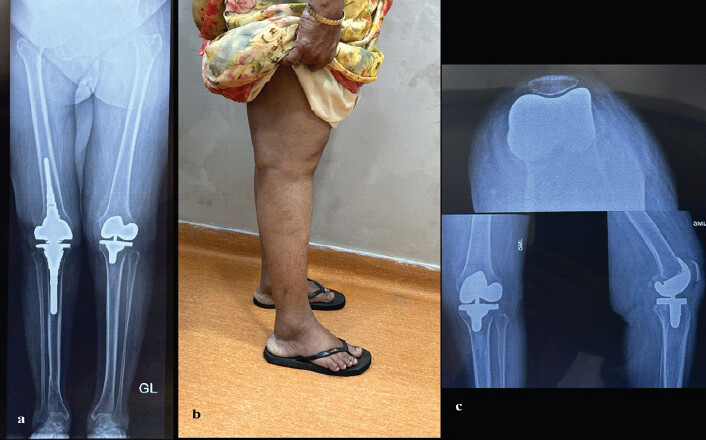 Figure 3: 5-year follow-up: (a) Long-leg composite radiograph, (b) Clinical photograph, (c) Radiographs of contralateral knee.