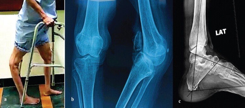 Figure 4: Pre-operative (Case 2) (a) Standing photograph showing recurvatum deformity (b) Anteroposterior and (c) Radiograph of the ankle showing calcaneus deformity (A-Tibiocalcaneal angle - 42°, B -Calcaneal pitch - 38°, C-Talocalcaneal angle - 65°).