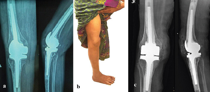 Figure 5: Post-operative radiographs (a), 4-year follow-up clinical photograph (b), and radiographs (c).