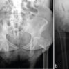 Superior Gluteal Artery Injury After Cephalomedullary Nailing of a Hip Fracture in a Patient on Anticoagulation: A Case Report and Literature Review