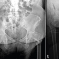 Figure 1: (a) Pre-operative anteroposterior radiograph of the left hip demonstrating a displaced intertrochanteric femur fracture. (b) Pre-operative lateral radiograph of the left hip demonstrating a displaced intertrochanteric femur fracture.