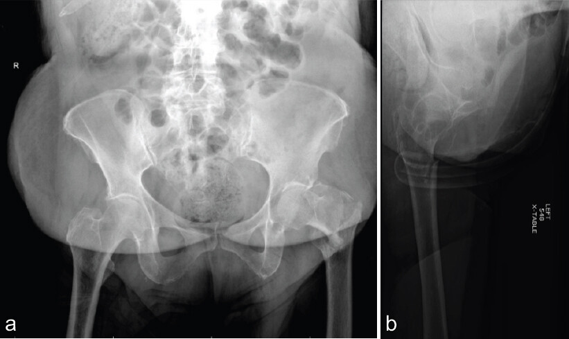 Figure 1: (a) Pre-operative anteroposterior radiograph of the left hip demonstrating a displaced intertrochanteric femur fracture. (b) Pre-operative lateral radiograph of the left hip demonstrating a displaced intertrochanteric femur fracture.