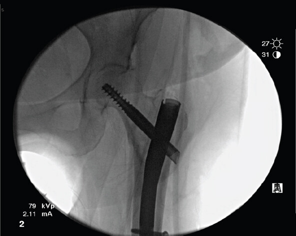 Figure 2: Post-operative anteroposterior radiograph of the left hip following open reduction and internal fixation with a cephalomedullary nail.