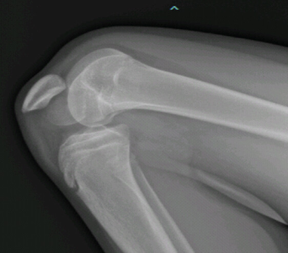 Figure 2: Initial plain radiograph; Initial plain radiograph of the knee demonstrating a Hoffa fracture with the patella locked behind the fractured condylar fragment (circle).