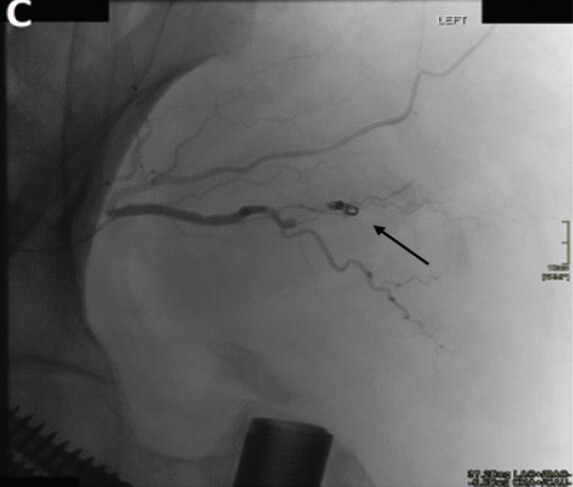 Figure 3: Intraoperative angiogram demonstrating successful hemostasis achieved following selective coil embolization.