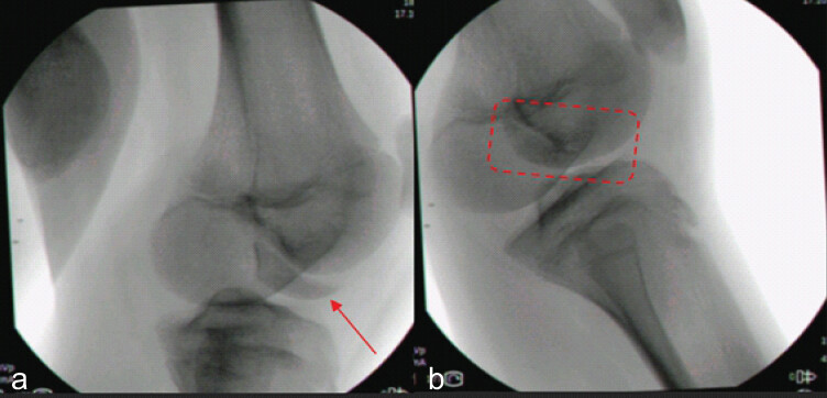 Figure 3: (a) Intraoperative fluoroscopic image; intraoperative fluoroscopic image obtained before closed reduction, demonstrating the Hoffa fragment (arrow). (b) Intraoperative fluoroscopic image; Intraoperative fluoroscopic image confirming maintained anatomical reduction of the fracture fragment (rectangle) and satisfactory patellofemoral alignment.