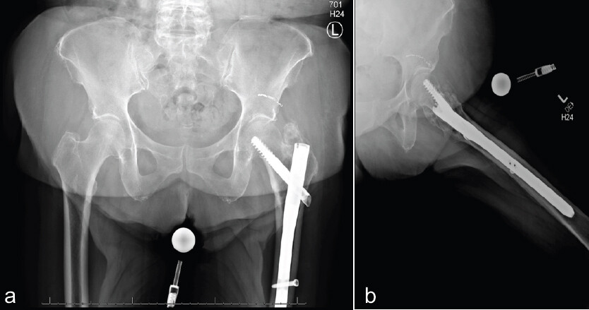 Figure 4: (a) Follow-up AP radiograph of the left hip demonstrating appropriate fracture healing and stable hardware positioning following cephalomedullary nail fixation and superior gluteal artery embolization. (b) Follow-up lateral radiograph of the left hip demonstrating appropriate fracture healing and stable hardware positioning following cephalomedullary nail fixation and superior gluteal artery embolization.
