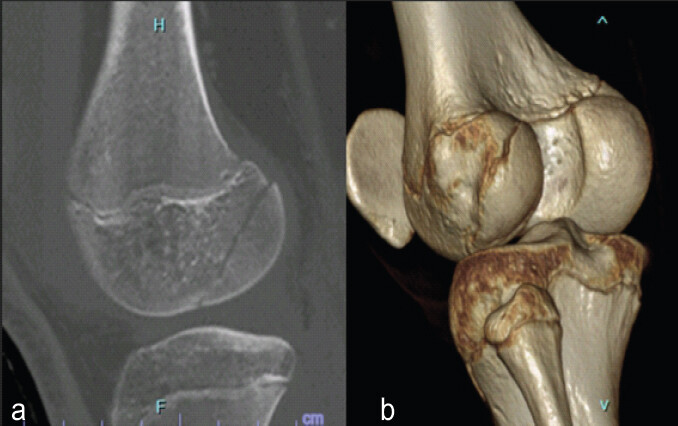 Figure 4: (a) Computed tomography (CT); CT scan obtained after closed reduction under general anesthesia demonstrating an anatomical reduction of the Hoffa fracture. (b) Three-dimensional CT; three-dimensional CT reconstruction following closed reduction under general anesthesia, illustrating the anatomical reduction of the fracture fragment.