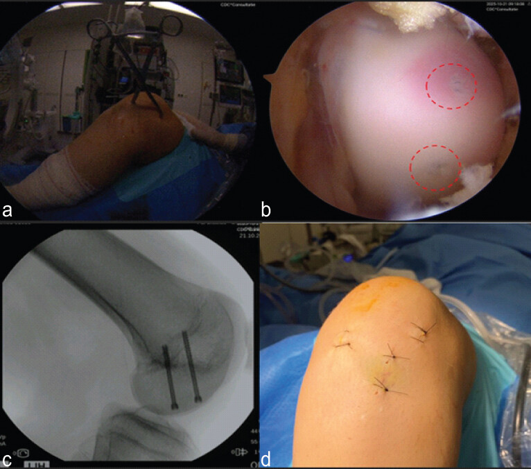 Figure 5: (a) Intraoperative photograph; intraoperative photograph during the second procedure showing a pointed reduction clamp temporarily stabilizing the Hoffa fragment. (b) Arthroscopic view; arthroscopic view of the femoral condyle after screw fixation, demonstrating an anatomically restored articular surface with minimally damaged cartilage (circles). (c) Intraoperative fluoroscopic image; intraoperative fluoroscopic image during definitive fixation demonstrating two screws securing the Hoffa fragment in anatomical position. (d) Post-operative photograph; post-operative photograph showing arthroscopic portal incisions and the entry points of the fixation screws after wound closure.