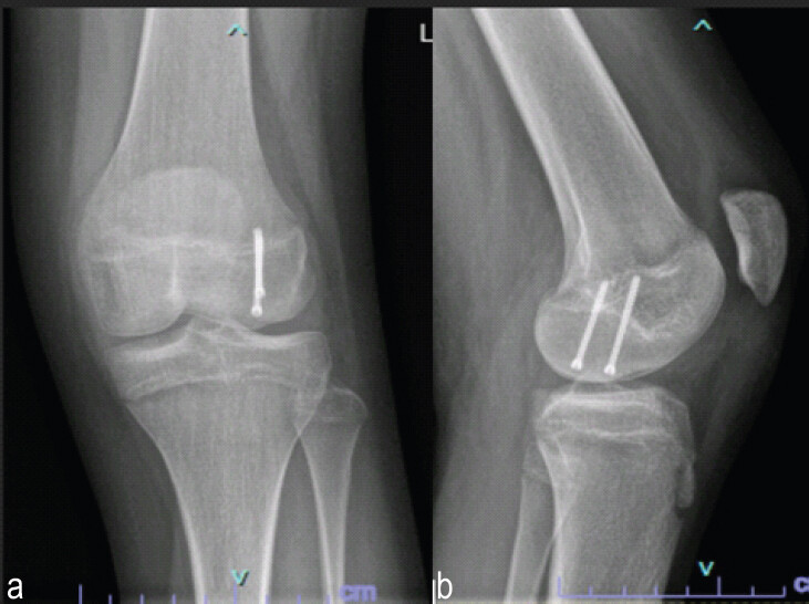 Figure 6: (a and b) Immediate post-operative radiograph; immediate post-operative anteroposterior (a) and lateral (b) radiograph confirming anatomical reduction and appropriate positioning of the fixation screws.