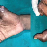 Figure 1: Pre-operative clinical presentation. Pre-operative clinical photographs demonstrating marked swelling and localized cutaneous involvement of the right thumb in an 18-year-old male with chronic osteomyelitis.
