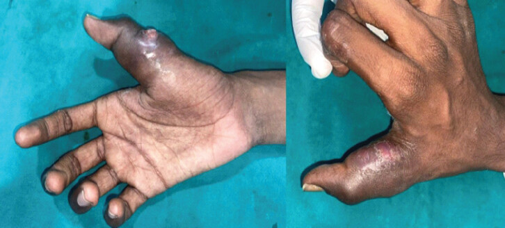 Figure 1: Pre-operative clinical presentation. Pre-operative clinical photographs demonstrating marked swelling and localized cutaneous involvement of the right thumb in an 18-year-old male with chronic osteomyelitis.