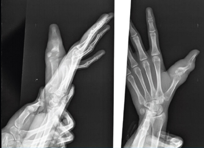 Figure 2: Pre-operative radiographic assessment of the right thumb. Anteroposterior and oblique radiographic views demonstrating destructive and erosive changes involving the proximal phalanx of the right thumb with associated osseous irregularity and surrounding soft-tissue swelling.