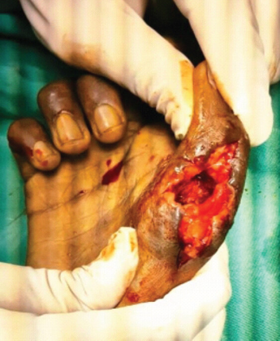 Figure 3: Intraoperative findings. Intraoperative findings demonstrating infected and necrotic tissue and bone involving the right thumb during surgical exploration and debridement.