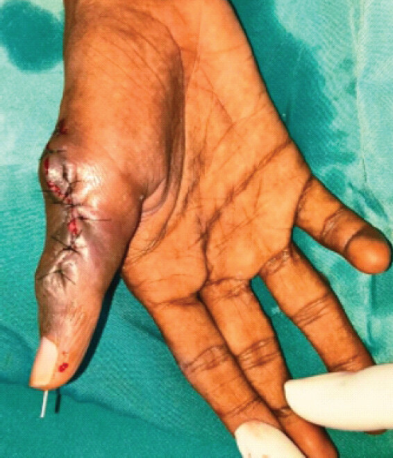 Figure 4: Surgical reconstruction. Immediate post-operative image demonstrating K-wire stabilization of the affected thumb following debridement and local antibiotic cement bead placement.