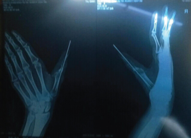 Figure 5: Post-operative radiographs. Post-operative radiographs demonstrating K-wire stabilization of the affected thumb with maintained alignment following surgical debridement.