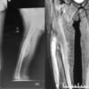 Development of a Non-ossifying Fibroma in the Same Femur 6 Years after Limb-Salvage Surgery for Osteosarcoma: A Case Report