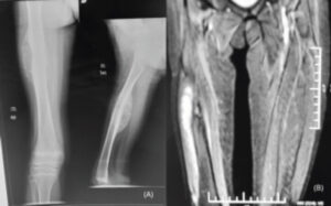Figure 1: Pre-operative imaging demonstrating the primary malignant lesion of the right femur. (a) Anteroposterior and lateral radiographs showing an aggressive osteolytic lesion involving the femoral shaft with cortical destruction and periosteal reaction, suggestive of a malignant bone tumor. (b) Coronal magnetic resonance image demonstrating marrow involvement with extension into the adjacent soft tissues, consistent with a high-grade primary bone malignancy.