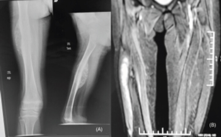 Figure 1: Pre-operative imaging demonstrating the primary malignant lesion of the right femur. (a) Anteroposterior and lateral radiographs showing an aggressive osteolytic lesion involving the femoral shaft with cortical destruction and periosteal reaction, suggestive of a malignant bone tumor. (b) Coronal magnetic resonance image demonstrating marrow involvement with extension into the adjacent soft tissues, consistent with a high-grade primary bone malignancy.