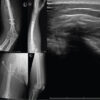 Extensive Post-Traumatic Heterotopic Ossification with Multi-joint Involvement: A Case Report