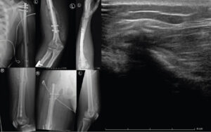 Figure 1: Radiographs and ultrasound at 1-month post-trauma demonstrating heterotopic ossification. Radiographs at 1-month post-trauma demonstrating heterotopic ossification of the left shoulder, humerus and forearm, right hip, both quadriceps muscles (left image) and ultrasound of the right anterior femur with hyperechoic fragments within the quadriceps muscle and associated posterior shadowing (right image).