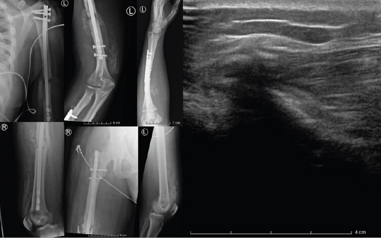 Figure 1: Radiographs and ultrasound at 1-month post-trauma demonstrating heterotopic ossification. Radiographs at 1-month post-trauma demonstrating heterotopic ossification of the left shoulder, humerus and forearm, right hip, both quadriceps muscles (left image) and ultrasound of the right anterior femur with hyperechoic fragments within the quadriceps muscle and associated posterior shadowing (right image).