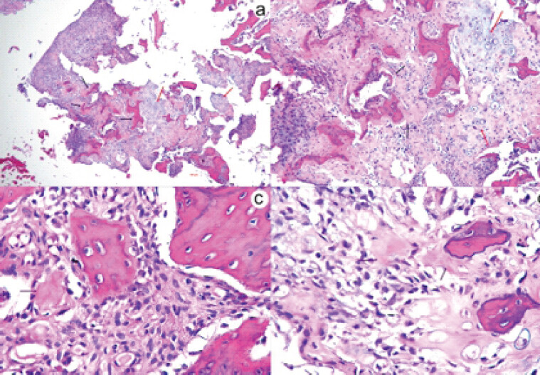 Figure 2: Histopathological features of the primary lesion. (a) Hematoxylin and eosin (H and E), ×40 and (b) ×100 magnification showing a mesenchymal neoplasm with irregular osteoid deposition (black arrows) and areas of chondroid differentiation (red arrow). The osteoid is predominantly woven and appears as eosinophilic, haphazard, lace-like structures. Tumor cells show marked nuclear hyperchromasia and an increased nuclear-to-cytoplasmic ratio. (c and d) H and E, ×400 magnification showing atypical spindle-to-polygonal tumor cells embedded within a chondroid matrix.