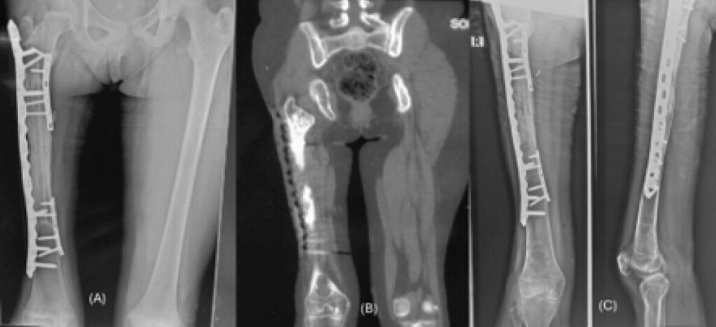 Figure 3: Post-operative imaging demonstrating interval development of a distal femoral lesion. (a) Immediate post-operative radiograph after wide resection, ECRT, and reimplantation with internal fixation, showing no distal femoral lesion. (b) Coronal computed tomography image demonstrating a well-defined cortically based metaphyseal lesion in the distal femur. (c) Follow-up radiographs showing persistence of the distal femoral lesion with healing and incorporation of the ECRT -treated femoral segment. ECRT: Extracorporeal radiotherapy.