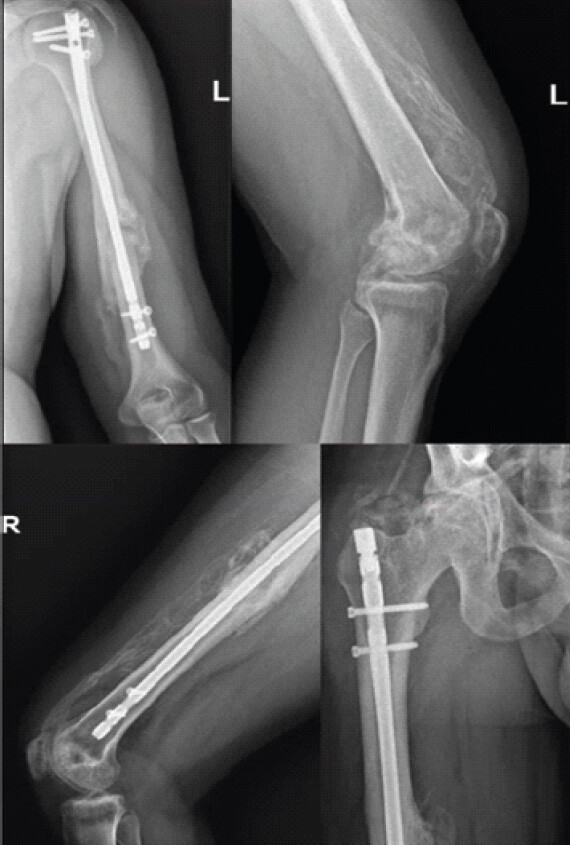 Figure 3: Follow-up radiographs at 8-month post-trauma of the left humerus, knee, and right femur. Follow-up radiographs at 8-month post-trauma of the left humerus and knee (upper panels) and right femur and hip (lower panels), demonstrating mature heterotopic ossification with defined cortical margins.