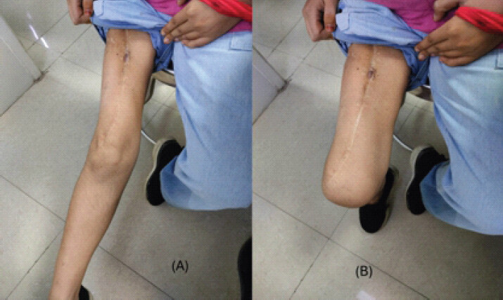 Figure 4: Clinical photographs at final follow-up demonstrating satisfactory post-operative knee range of motion. (a) Knee flexion. (b) Knee extension.