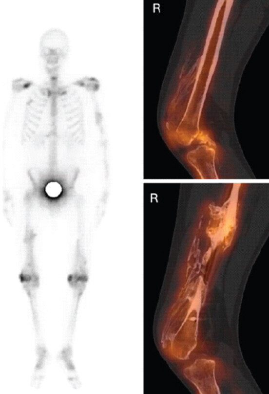 Figure 4: Single photon emission computed tomography (SPECT) at 8-month post-trauma demonstrating low-level tracer uptake indicating mature lesions. SPECT combined with computed tomography imaging performed 8 months after trauma. The images demonstrate low metabolic activity within the heterotopic ossifications, with only minimal residual tracer uptake in the distal anterior thigh region, consistent with mature and metabolically inactive lesions.