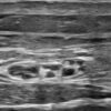 Chronic Neuropathy of the Lateral Antebrachial Cutaneous Nerve after Endoscopic Radial Artery Harvest: A Case Report