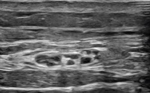 Figure 1: Ultrasound image before hydrodissection and nerve block injection of the left lateral antebrachial cutaneous nerve.