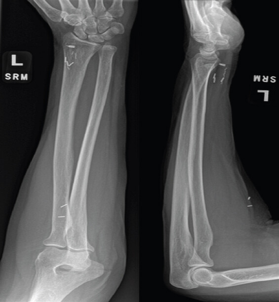 Figure 2: Anteroposterior and lateral radiographs demonstrating multiple surgical clips within the proximal and distal forearm.