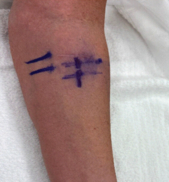 Figure 3: Horizontal markings signifying proximal and distal location of clips within forearm utilizing ultrasound. Vertical markings signifying midline location of clips within ultrasound window corresponding to each proximal and distal clip location.