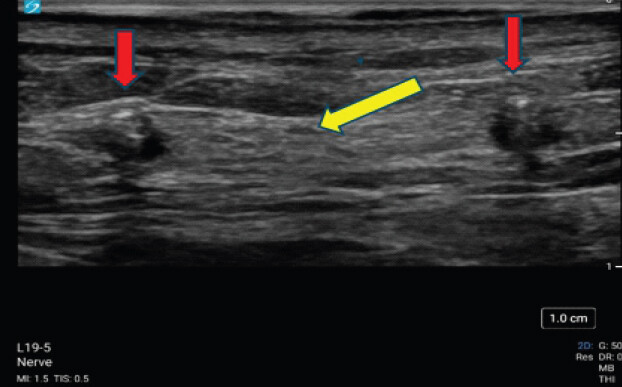 Figure 4: Intraoperative ultrasound demonstrating two surgical clips (red arrows) with placement close in proximity to the superficial nerve (yellow arrow).