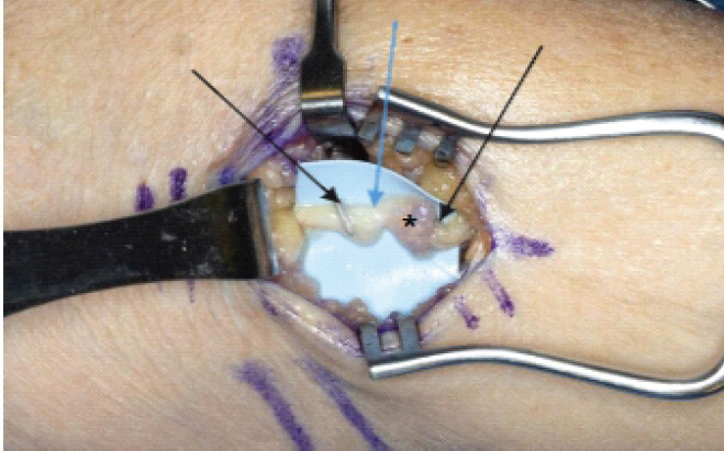 Figure 5: Intraoperative photograph of the left anterolateral forearm, showing the identified left antebrachial cutaneous nerve (blue arrow) with the metallic clips (black arrows), left being proximal and right being distal, as well as a damaged neural segment (asterisk).