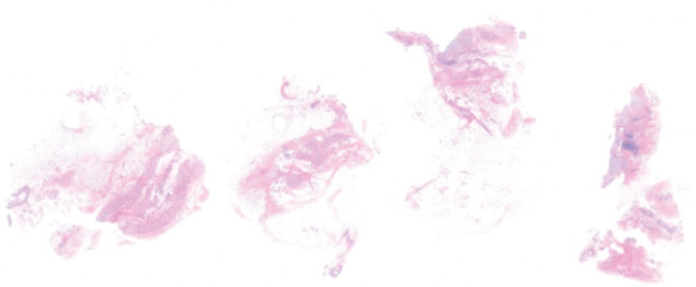 Figure 6: Histologic Hematoxylin and Eosin stain confirming perineural fibrosis and chronic inflammation.