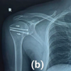Surgical Management of Chronic Locked Posterior Dislocation of Shoulder using the Modified McLaughlin Procedure