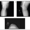 Chronic Bilateral Knee Pain Following Total Knee Arthroplasty Due to Titanium Allergy: A Case Report