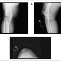 Figure 1: 2009 Radiographs of right knee, standing, 2 views. (A) Anteroposterior view, standing; (B) lateral view, standing; and (C) tangential patellar view.