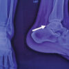 All Arthroscopic Decompression and Bone Grafting of Cyst in the Talus