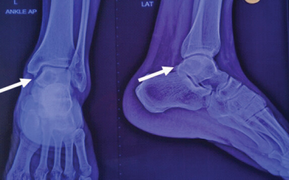 Figure 1: X-ray ankle anteroposterior and lateral view showing cyst in the talus.