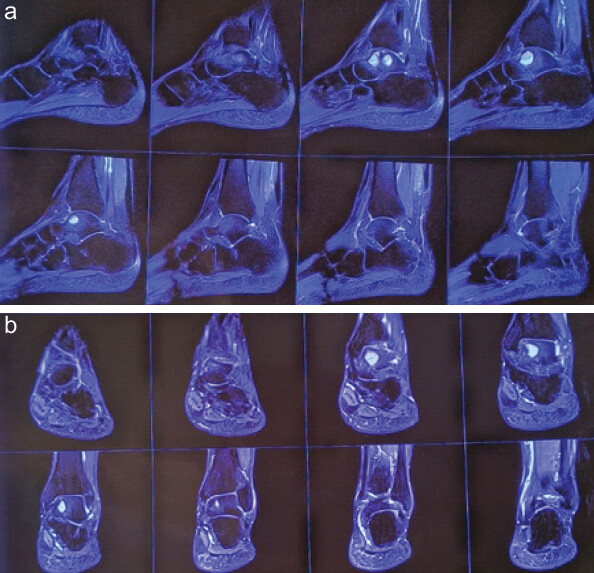 Figure 2: Magnetic resonance imaging showing cyst in anteromedial talus.