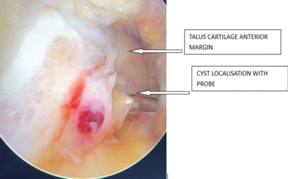 Figure 3: Arthroscopic view of cyst localization with probe.